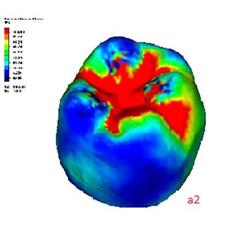 Dental gerilme analizlerinde NETFORM desteği